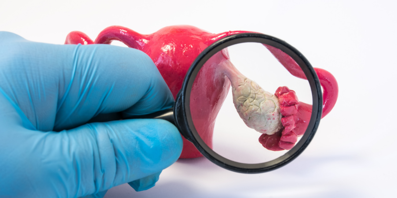 65-Ovaires-polykystiques-Peut-on-tomber-enceinte-_